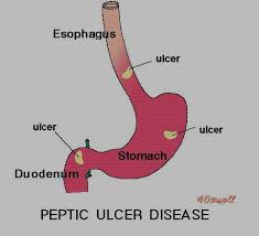 The urease enzyme it produces reacts with urea to form ammonia that neutralizes enough of the. Helicobacter Pylori Safe Drinking Water Foundation
