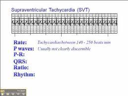 Svt, hasta tarafından kendi başına tedavi edilebildiğinden, ilk tedavi. Ecg Supraventricular Tachycardia Svt Youtube