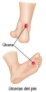 Ulceras De Pie Diabetico Care Guide Information En Espanol