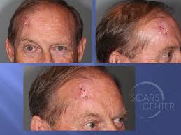 Some types of skin cancer are more dangerous than others, but if you have a spot. Staging Of Recurrent Extensive Basal Cell Carcinoma Of The Forehead Skin Cancer And Reconstructive Surgery Center