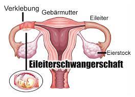 Der befruchteten eizelle (zygote) gelingt es hierbei nicht, den eileiter zu durchwandern. Eileiterschwangerschaft Gesund Co At