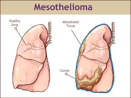 The pancreas is located behind the stomach, so having pancreatic cancer doesn't involve a palpable mass that you can feel. What Is Mesothelioma Its Symptoms Diagnosis And Treatment Tricky Care