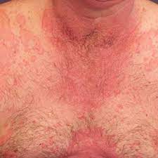 11 Pictures Of Anaphylaxis Symptoms