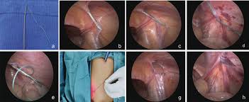 Image result for Inguinal hernia man