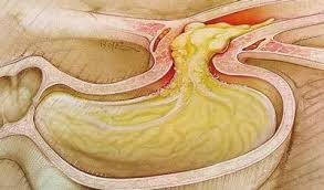 Le Reflux Gastro Oesophagien Ou Rgo Passionsante Be