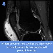 Image result for Prepatellar Bursitis