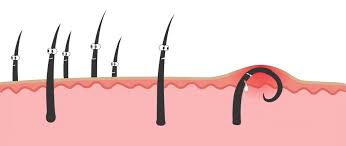 Kil Donmesi Ile Kil Batmasi Arasindaki Fark Nedir