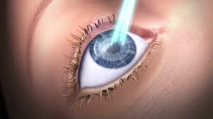 It works by using a laser to help the fluid in your eye drain away, which can help to lower the pressure inside your eye. Types Of Eye Surgery Schwind