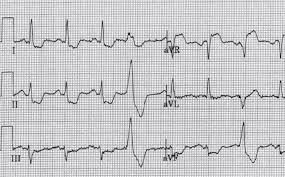 Image result for ST Elevation