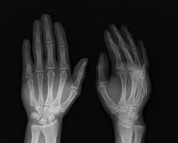 Image result for Scaphoid Fracture Signs