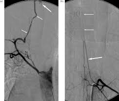 Internal iliac embolotherapy was performed in 108 of 127 patients (85.0%). Haemoptysis And Bronchial Artery Embolization In Children Sciencedirect