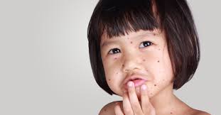 مدة مرض الجدري وكيفية العلاج ويب طب