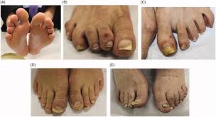 Image result for Onycholysis feet