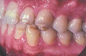 What Are The Signs Of Enamel Dysplasia Westermeier Martin Dental Care