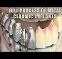 Full Process of Metal Ceramic Implants - YouTube