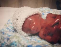 This week marks her move into the fetal stage, which lasts until she's born (moore et al 2019a). Born At 18 Weeks Premature Baby Luke Was Absolutely Perfect
