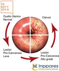 Los sintomas del cáncer de cuello de útero incluyen carencia de síntomas, secreción vaginal, olor vaginal, flujo vaginal con sangre, sangrado vaginal anormal, dolor pélvico, síntomas de vejiga, sangre en la orina, síntomas. Facebook