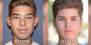 When it reaches this point, your eye doctor may suggest having cataract surgery. Get The Best Advice For Your Cosmetic Surgery Kongartspace