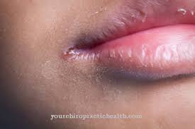 Mudah lelah dan tidak bersemangat : Sudut Mulut Terkoyak Sebab Gejala Rawatan Penyakit