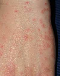 Image result for scabies on humans