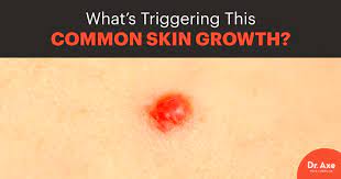 These appear on the lips and. Cherry Angioma Risk Factors Symptoms Natural Treatments Dr Axe