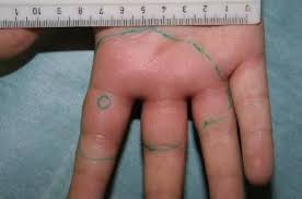 Image result for yellow sac spider bite skin