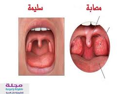 صوره لوز ملتهبه ما هو التهاب البلعوم و التهاب اللوزتين ي عد كل من التهاب البلعوم والتهاب اللوزتين إذا تأث sore throat strep throat remedies soreness