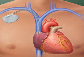 The pacing of the heart was accomplished by subcutaneous electrodes but could be. 12 Marcapasos 1 Dr Rahul Patil