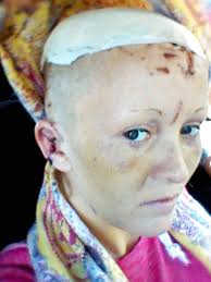 My psycho ex SCALPED me and beat me unconscious in two-hour ordeal