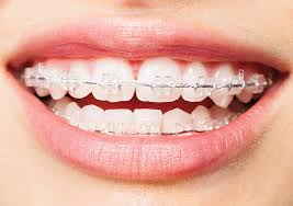 The ceramic braces cost a little more than the metal ones at $4,000 to $8,000, while the lingual braces are really expensive at $8,000 to $10,000. Adult Braces Are A Growing Trend Find Out Why And Why Now