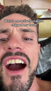 Chipped Tooth in Paris: Can Anyone Relate?