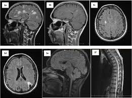 Multiple sclerosis (abbreviated ms, known as disseminated sclerosis or encephalomyelitis disseminata) is an inflammatory disease in which the fatty myelin sheaths around the axons of the. Differential Diagnosis Of Multiple Sclerosis And Other Inflammatory Cns Diseases Multiple Sclerosis And Related Disorders