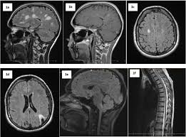 Find answers to health issues you can trust from healthgrades.com. Differential Diagnosis Of Multiple Sclerosis And Other Inflammatory Cns Diseases Multiple Sclerosis And Related Disorders