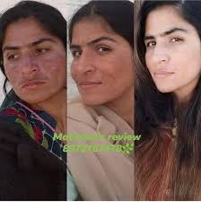 Hello, I am a Skin and Health consultant and I've helped many people with  skin problems like acne, pore, and pockmarks etc. I can also help you in  weight loss/gain, nutrient deficiency,