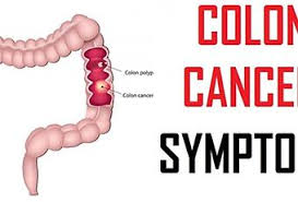 The grade describes the appearance of the cancerous cells. Stage 4 Colon Cancer Symptoms Colorectal Cancer Paperblog