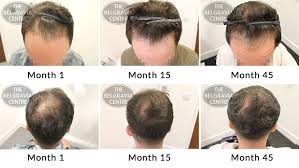 Hair transplant, or restoration surgery, can make the most of the hair you have left. Success Story Alert New Male Pattern Baldness Entry