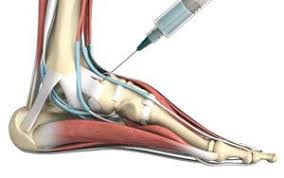 Image result for Joint Injection