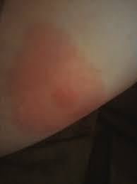 Symptoms of a mosquito bite or mosquito allergy. Black Widow Bite Survivors Bugs Forum At Permies