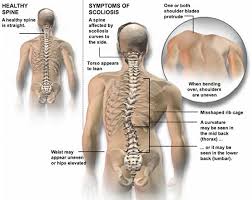 About the size of a fist. Scoliosis