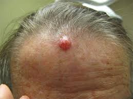 It is also used to destroy any remaining cancer cells after surgery. Skin Cancer Precancerous Treatments Norris Dermatology Portland
