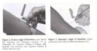 You need to know that injured blood vessels will leak the blood for small amount. Specimen Collection Procedure Performing A Venipuncture Akron Children S Hospital
