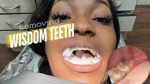 Can You Take Vape After Tooth Extraction Wisdom Teeth Removal Henderson, NV 