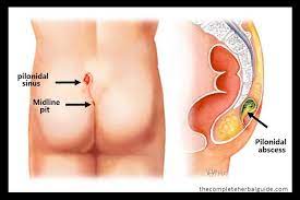 Top 10 Home Remedies For Pilonidal Cysts Pilonidal Cyst Cysts Remedies