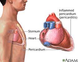 Some of the most common infections which cause myocarditis. Pericarditis Medlineplus Medical Encyclopedia