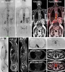 Mixed sclerotic lesions, including right sixth rib head as suggested on cxr, left lateral eighth rib and sternal sclerosis. Whole Body Diffusion Weighted Magnetic Resonance Imaging Diagnosis And Follow Up Of Prostate Cancer And Beyond Yoshida 2021 International Journal Of Urology Wiley Online Library