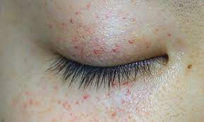 In old age, skin becomes thinner and fragile. A Rash Localised Around The Eyes The Bmj