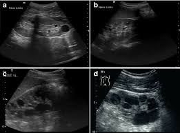 Typical Sonographic Images Of Autosomal Dominant Polycystic Kidney Download Scientific Diagram