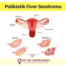Polikistik Over Sendromu Santral Sinir Sistemi Hipofiz Bezi Yumurtaliklar Bobrekustu Bezi Ve Diger Dokular Arasind Polikistik Over Sendromu Genetik Hipofiz