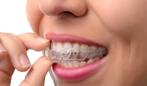 Doing business as:linco group, llc, the the linco group. Does Insurance Cover Invisalign In North Carolina Myorthodontist