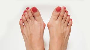 Hallux Rigidus Physiopedia